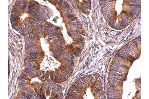 IHC-P Image Survivin antibody detects Survivin protein at cytosol on human colon carcinoma by immunohistochemical analysis. (Survivin antibody)