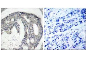 Immunohistochemical analysis of paraffin-embedded human breast carcinoma tissue using eNOS (phospho-Ser1176) antibody (E011156). (ENOS antibody  (pSer1176))