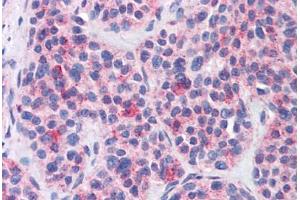 Anti-MBOAT4 antibody  ABIN1102980 IHC staining of human thyroid, medullary carcinoma. (MBOAT4 antibody  (Internal Region))