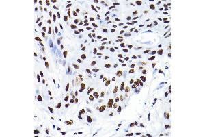 Immunohistochemistry of paraffin-embedded human esophageal cancer using K/K/TRIM28 Rabbit pAb  at dilution of 1:200 (40x lens).