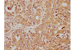 IHC image of ABIN7127407 diluted at 1:155 and staining in paraffin-embedded human liver cancer performed on a Leica BondTM system. (Recombinant CD63 antibody)
