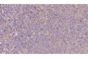 ABIN6273065 at 1/100 staining Human lymph cancer tissue by IHC-P. (PKLR antibody  (Internal Region))