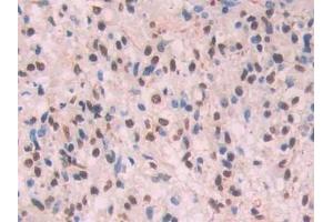 Detection of Ab1-42 in Human Glioma Tissue using Monoclonal Antibody to Amyloid Beta Peptide 1-42 (Ab1-42) (Abeta 1-42 antibody)