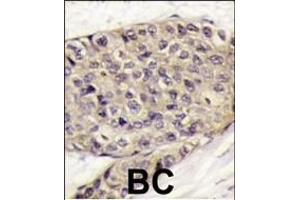 Formalin-fixed and paraffin-embedded human breast carcinoma tissue reacted with VEGF Antibody (C-term) (ABIN6242881 and ABIN6578974) , which was peroxidase-conjugated to the secondary antibody, followed by DAB staining. (VEGF antibody  (C-Term))