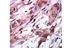 IHC analysis of FFPE human breast carcinoma tissue stained with the AURKC antibody (Aurora Kinase C antibody  (C-Term))