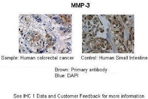 Application: IHC Species+tissue/cell type: Control-Human small intestine, Sample-human colorectal cancer Primary antibody dilution: 1:100 Secondary antibody: Biotinylated pig anti-rabbit+streptavidin-HRP (MMP3 antibody  (Middle Region))