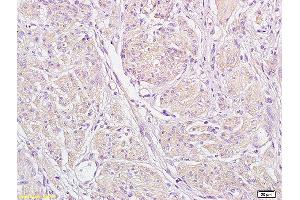 Formalin-fixed and paraffin embedded human endometrial carcinoma labeled with Anti-STIM1 Polyclonal Antibody, Unconjugated (ABIN1387605) at 1:200 followed by conjugation to the secondary antibody and DAB staining (STIM1 antibody  (AA 85-180))