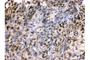Anti- HSPA2 Picoband antibody,IHC(P) IHC(P): Human Lung Cancer Tissue (HSPA2 antibody  (C-Term))