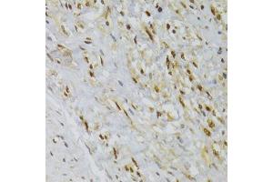 Immunohistochemistry of paraffin-embedded human adenomyosis using HNRNPA1 Antibody (ABIN5975570) at dilution of 1/100 (40x lens). (HNRNPA1 antibody)