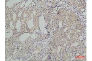 Immunohistochemistry (IHC) analysis of paraffin-embedded Human Breast Carcicnoma using SLUG Polyclonal Antibody. (SLUG antibody)