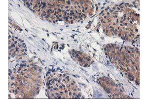 Immunohistochemical staining of paraffin-embedded Adenocarcinoma of Human breast tissue using anti-GBA3 mouse monoclonal antibody. (GBA3 antibody  (AA 1-150, AA 370-469))