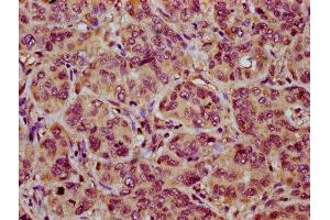 IHC image of ABIN7161019 diluted at 1:200 and staining in paraffin-embedded human liver cancer performed on a Leica BondTM system. (NOXO1 antibody  (AA 304-376))