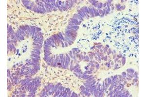 Immunohistochemistry of paraffin-embedded human ovarian cancer using ABIN7144840 at dilution of 1:100 (ATP5B antibody  (AA 230-529))