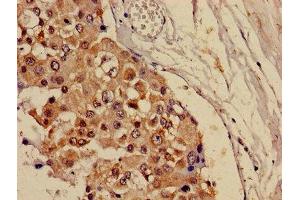 Immunohistochemistry of paraffin-embedded human breast cancer using ABIN7146825 at dilution of 1:100 (CRAT antibody  (AA 181-346))