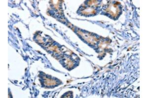 The image on the left is immunohistochemistry of paraffin-embedded Human colon cancer tissue using ABIN7191031(IBSP Antibody) at dilution 1/50, on the right is treated with synthetic peptide. (IBSP antibody)