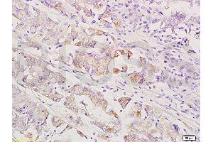 Formalin-fixed and paraffin embedded human gastric carcinoma labeled with Anti-MEK1/2(MAPKK1) Polyclonal Antibody, Unconjugated (ABIN736791) at 1:200 followed by conjugation to the secondary antibody and DAB staining. (MEK1/2 antibody  (AA 301-393))