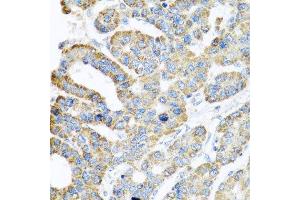 Immunohistochemistry of paraffin-embedded human liver cancer using ATPIF1 antibody at dilution of 1:100 (x40 lens). (ATPase Inhibitory Factor 1 antibody)