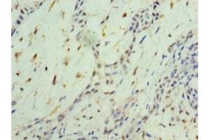 Immunohistochemistry of paraffin-embedded human breast cancer using ABIN7161910 at dilution of 1:100 (NR4A1 antibody  (AA 1-170))