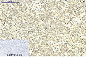 Immunohistochemical analysis of paraffin-embedded human breast cancer tissue. (ABCB5 antibody)