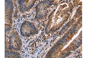 The image on the left is immunohistochemistry of paraffin-embedded Human colon cancer tissue using ABIN7129424(FAAH2 Antibody) at dilution 1/30, on the right is treated with fusion protein.