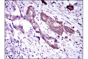 Immunohistochemical analysis of paraffin-embedded esophageal cancer tissues using DNAL4 mouse mAb with DAB staining.