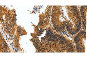 Immunohistochemistry of paraffin-embedded Human colon cancer tissue using BIRC6 Polyclonal Antibody at dilution 1:30 (BIRC6 antibody)