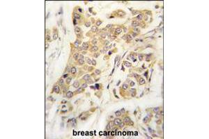 Formalin-fixed and paraffin-embedded human breast carcinoma tissue reacted with CDH8 antibody , which was peroxidase-conjugated to the secondary antibody, followed by DAB staining.