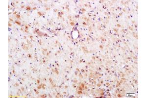 Formalin-fixed and paraffin embedded human gastric carcinoma labeled with Anti-S100A13 Polyclonal Antibody, Unconjugated (ABIN748073) at 1:200 followed by conjugation to the secondary antibody and DAB staining. (S100A13 antibody  (AA 51-98))
