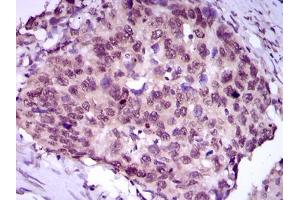 Immunohistochemical analysis of paraffin-embedded esophageal cancer tissues using MEF2C mouse mAb with DAB staining. (MEF2C antibody  (AA 1-125))