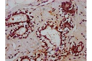 IHC image of ABIN7172427 diluted at 1:600 and staining in paraffin-embedded human breast cancer performed on a Leica BondTM system. (TCEA3 antibody  (AA 79-169))