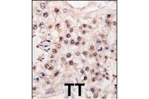 Formalin-fixed and paraffin-embedded human testicle tumor tissue reacted with HDAC11 antibody (C-term) (ABIN387965 and ABIN2844703) , which was peroxidase-conjugated to the secondary antibody, followed by DAB staining. (HDAC11 antibody  (C-Term))