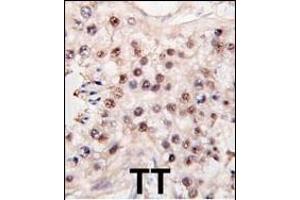 Formalin-fixed and paraffin-embedded human testicle tumor tissue reacted with HDAC11 antibody (C-term) (ABIN387965 and ABIN2844703) , which was peroxidase-conjugated to the secondary antibody, followed by DAB staining.