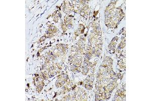 Immunohistochemistry of paraffin-embedded human breast cancer using PSAP Rabbit pAb (ABIN3022605, ABIN3022606, ABIN3022607, ABIN1513432 and ABIN6218938) at dilution of 1:50 (40x lens). (Prosaposin antibody  (AA 60-310))