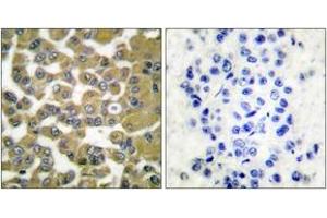 Immunohistochemistry analysis of paraffin-embedded human breast carcinoma tissue, using MMP-11 Antibody. (MMP11 antibody  (AA 61-110))