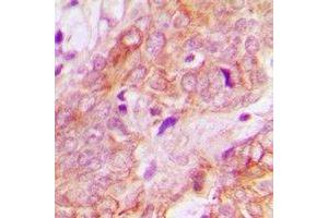 Immunohistochemical analysis of UBE3B staining in human breast cancer formalin fixed paraffin embedded tissue section. (UBE3B antibody)