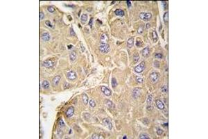 Formalin-fixed and paraffin-embedded human hepatocarcinoma tissue reacted with PTPN7 Antibody, which was peroxidase-conjugated to the secondary antibody, followed by DAB staining. (PTPN7 antibody  (Ser44))