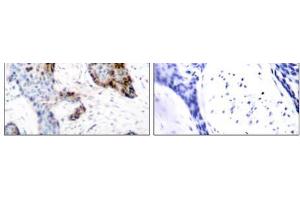 Immunohistochemical analysis of paraffin-embedded human breast carcinoma tissue using Estrogen Receptor-α (Ab-118) antibody (E021067). (Estrogen Receptor alpha antibody)
