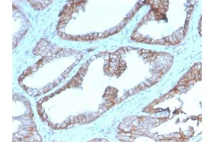 Formalin-fixed, paraffin-embedded human Prostate Carcinoma stained with CD47 Mouse Monoclonal Antibody (IAP/2937). (CD47 antibody  (AA 18-135))