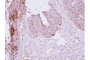 IHC-P Image Immunohistochemical analysis of paraffin-embedded human colon carcinoma, using MCC, antibody at 1:250 dilution. (MCC antibody  (Center))