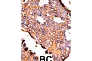 Formalin-fixed and paraffin-embedded human cancer tissue reacted with the primary antibody, which was peroxidase-conjugated to the secondary antibody, followed by AEC staining. (Riboflavin Kinase antibody  (N-Term))