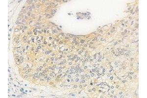 ABIN6262683 and ABIN6278907 at 1/100 staining human cervical carcinoma by IHC-P. (ITGA8 antibody  (C-Term))