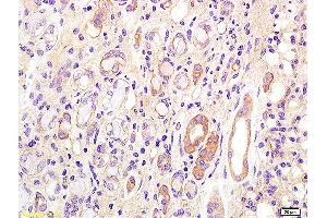 Formalin-fixed and paraffin embedded human kidney carcinoma labeled with Anti CD75 Polyclonal Antibody, Unconjugated (ABIN704201) at 1:200 followed by conjugation to the secondary antibody and DAB staining. (ST6GAL1 antibody  (AA 301-406))