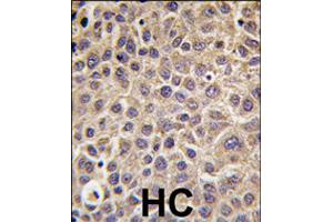 Immunohistochemistry (Formalin/PFA-fixed paraffin-embedded sections) of human hepatocellular carcinoma with MTMR9 polyclonal antibody , followed by peroxidase-conjugated secondary antibody and DAB staining. (MTMR9 antibody  (C-Term))