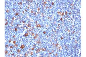 Formalin-fixed, paraffin-embedded human Hodgkin's Lymph stained with Fascin-1 Mouse Monoclonal Antibody (SPM133) (Fascin antibody)
