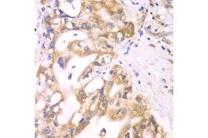 Immunohistochemistry of paraffin-embedded human liver cancer using ACADS antibody at dilution of 1:100 (x40 lens). (ACADS antibody)