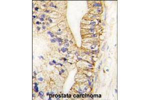 Formalin-fixed and paraffin-embedded human prostata carcinoma tissue reacted with CDH7 antibody , which was peroxidase-conjugated to the secondary antibody, followed by DAB staining. (Cadherin 7 antibody  (N-Term))