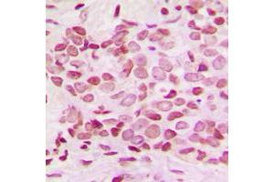 Immunohistochemical analysis of NF-kappaB p100 (pS865) staining in human breast cancer formalin fixed paraffin embedded tissue section. (NFKB2 antibody  (C-Term, pSer865))