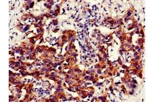 Immunohistochemistry of paraffin-embedded human bladder cancer using ABIN7161574 at dilution of 1:100 (NAMPT antibody  (AA 1-280))