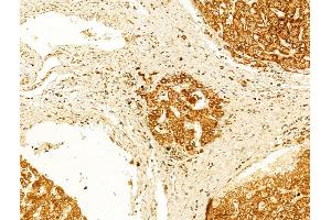 ABIN6262072 and ABIN6266555 at 1/100 staining Human normal tissues adjacent to liver cancer by IHC-P. (Granzyme B/H (N-Term) antibody)