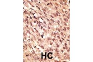 Formalin-fixed and paraffin-embedded human cancer tissue reacted with the primary antibody, which was peroxidase-conjugated to the secondary antibody, followed by AEC staining. (LRP5 antibody  (C-Term))